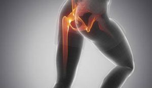 בורסיטיס של הירך: טרוכנטריק בורסיטיס -Trochanteric Bursitis