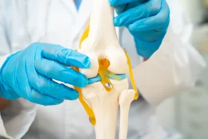 אוסטאוארתריטיס - דלקת מפרקים ניוונית